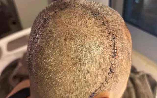 蔡一杰红馆演唱会自曝脑癌扩散，开颅手术伤口长达50厘米 现场图